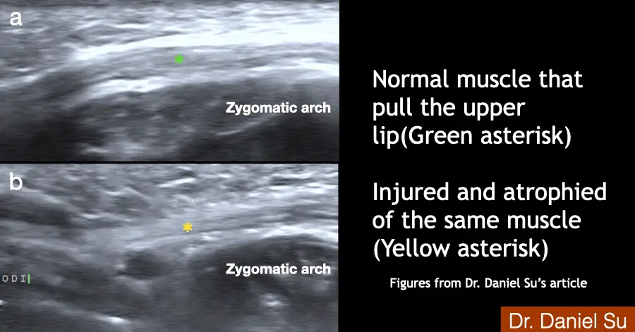 Two ultrasound images comparing a normal upper-lip elevator muscle with the same muscle injured and atrophied