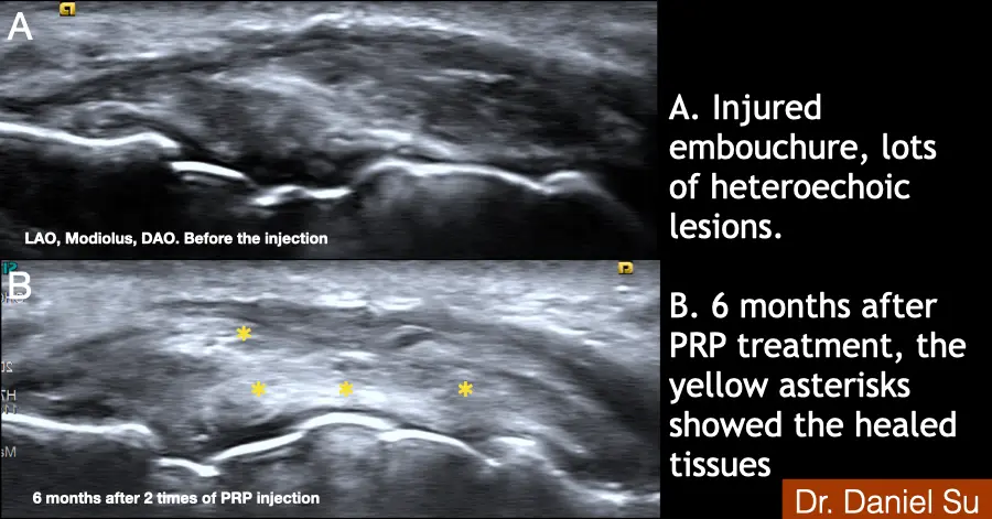 Ultrasound images of an injured embouchure before treatment and six months after PRP treatment