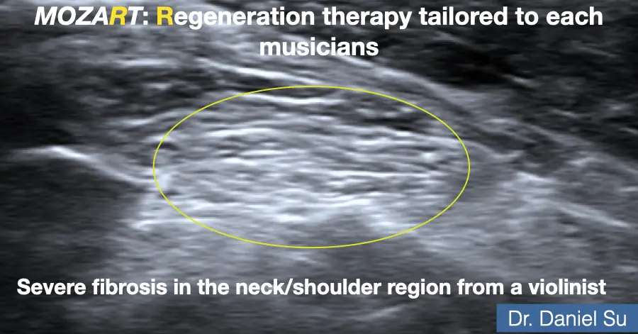 Ultrasound image showing an area of severe fibrosis in the neck and shoulder region of a violinist